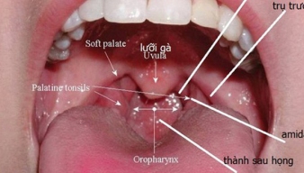 NHẬN BIẾT NHỮNG DẤU HIỆU BỊ UNG THƯ VÒM HÒNG