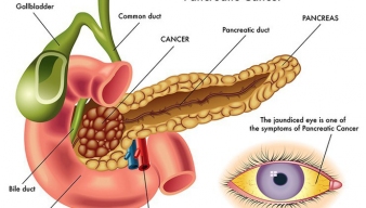 Viêm tuỵ cấp - diễn biến nhanh, cực kỳ nguy hiểm