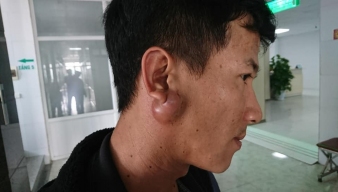 u tuyến nước bọt: Dấu hiệu, nguyên nhân, phương thức điều trị