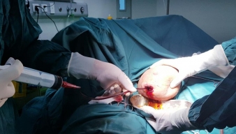Tự đắp lá chữa tắc tia sữa, bà mẹ bị áp xe vú phải phẫu thuật dẫn lưu áp xe mủ