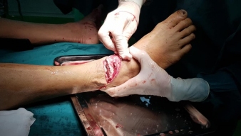 Mổ cấp cứu bệnh nhân bị tai nạn lao động: Hiểm họa khôn lường từ máy cắt cỏ