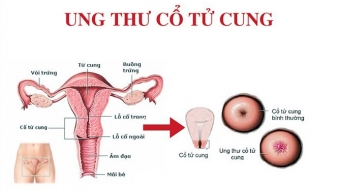 Những dấu hiệu nhận biết ung thư cổ tử cung