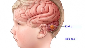 Cảnh báo u não ở trẻ