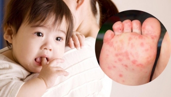 TAY CHÂN MIỆNG “RÌNH RẬP” - KHI NÀO CẦN ĐƯA TRẺ ĐI VIỆN?