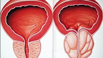 PHÌ ĐẠI TIỀN LIỆT TUYẾN - NHỮNG BIẾN CHỨNG NGUY HIỂM CẦN BIẾT!
