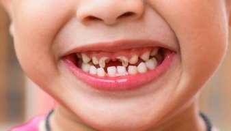 SÚN RĂNG Ở TRẺ NHỎ - HẬU QUẢ TO NẾU KHÔNG ĐƯỢC ĐIỀU TRỊ KỊP THỜI