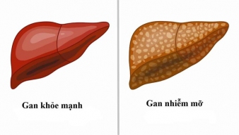 COI THƯỜNG GAN NHIỄM MỠ - DỄ BIẾN CHỨNG XƠ GAN