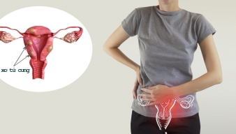 U XƠ TỬ CUNG ÂM THẦM TẤN CÔNG THIÊN CHỨC LÀM MẸ