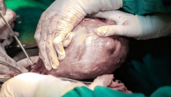 PHẪU THUẬT LOẠI BỎ KHỐI ĐA U XƠ TỬ CUNG KHỔNG LỒ NẶNG GẦN 5KG